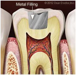 filling 2 filling 2