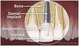 implant 1 implant 1