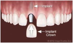 implant 2 implant 2