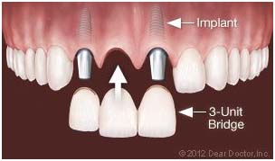 implant 3 implant 3