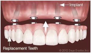 implant 4 implant 4