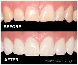 veneer 2 veneer 2